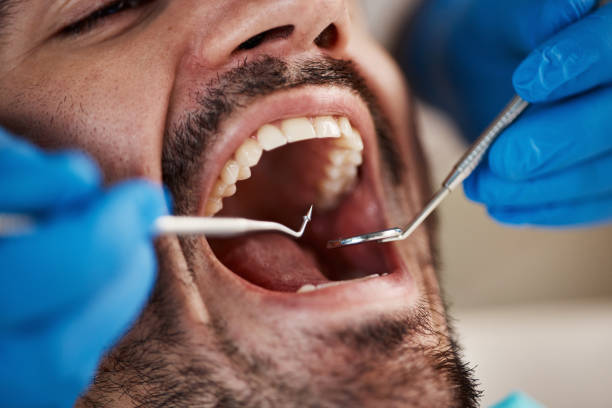 Best Emergency Root Canal Treatment in Midlothian, VA